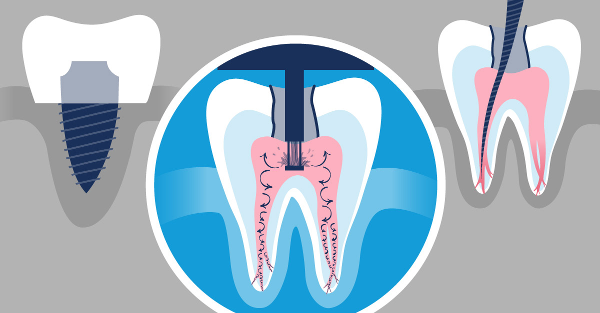 The Cost of a Dental Implant GentleWave Procedure